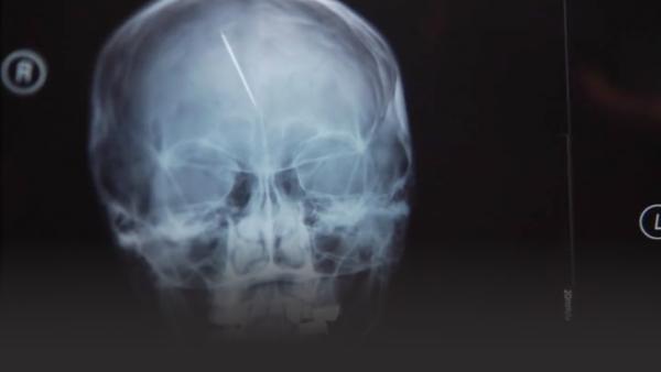 An x-ray of brain trauma caused by torture, needle insertion